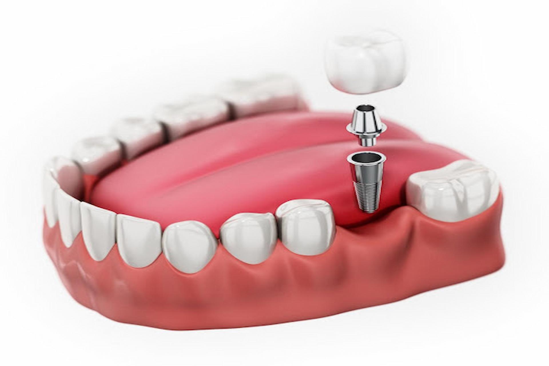 Dental Bridge & Dental Implant, Which One Is The Best Choice?