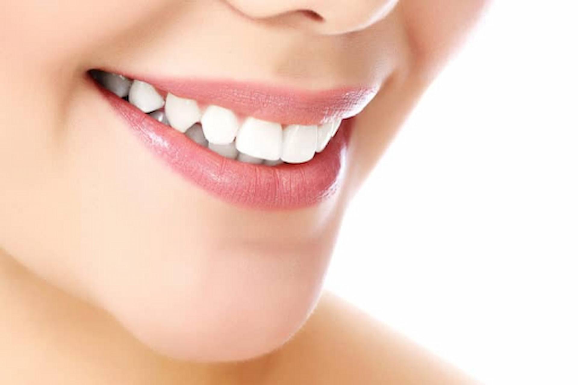 Essential Considerations Before Using Whitening Strips